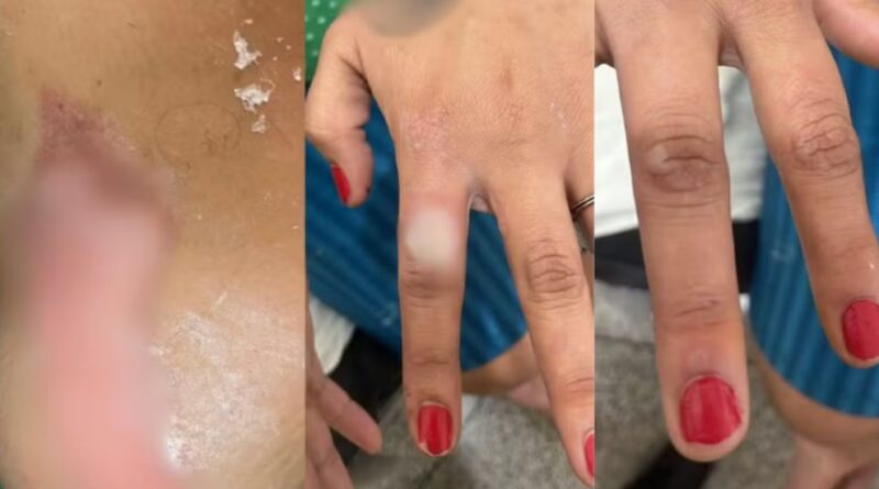 Homem é preso após atear fogo na namorada por causa de unhas vermelhas